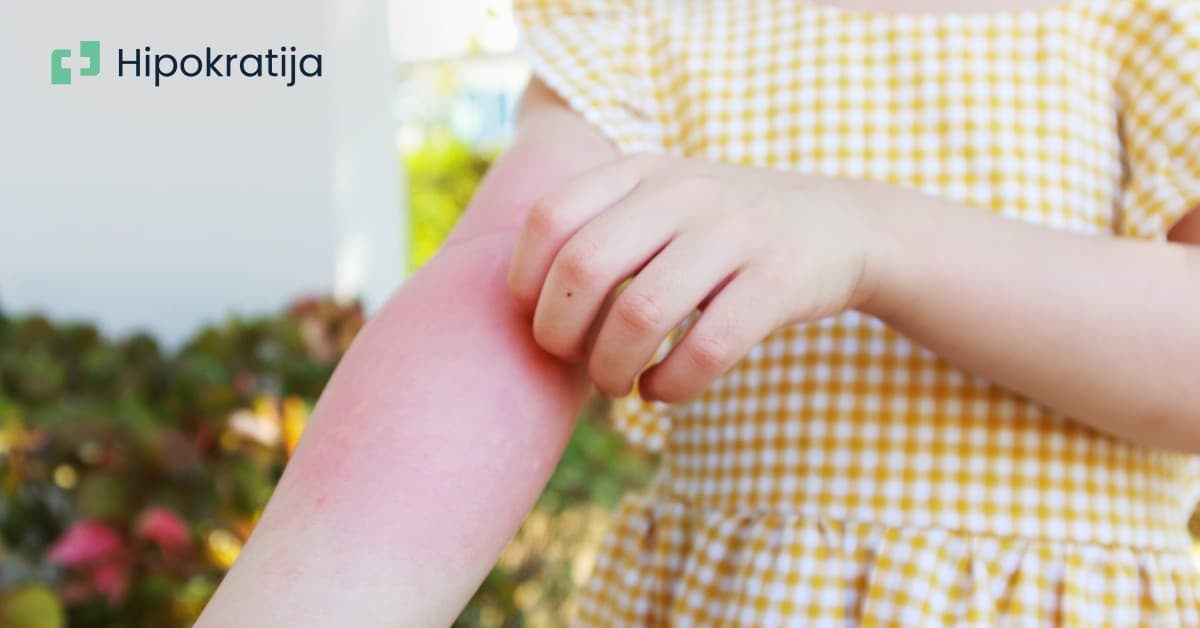 Cover Image for Ekcem kod beba i djece: Kako se nositi sa atopijskim dermatitisom u ranom uzrastu?