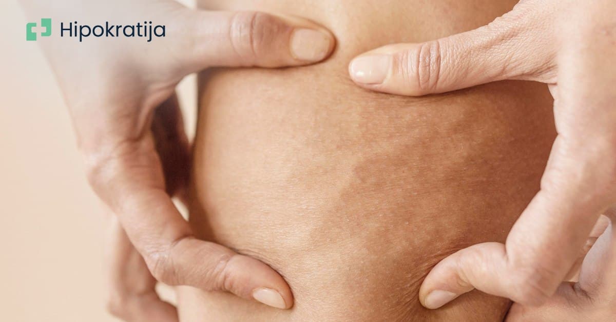 Cover Image for Kako se resiti celulita?