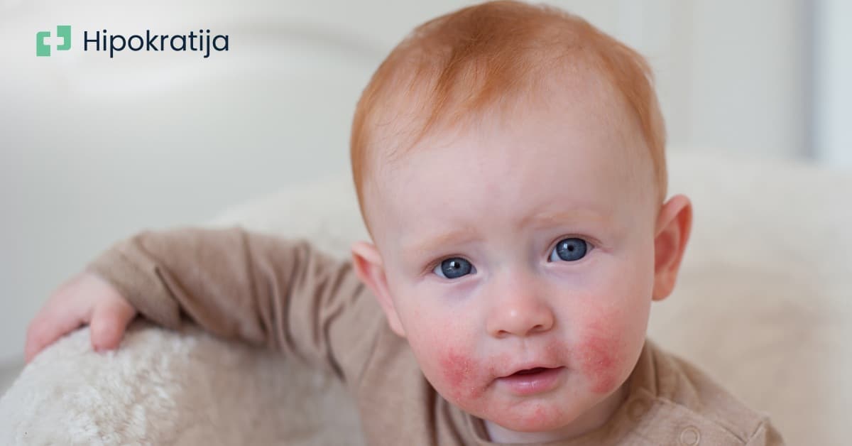 Cover Image for Atopijski dermatitis: Sve što treba da znate o ovoj upornoj kožnoj bolesti