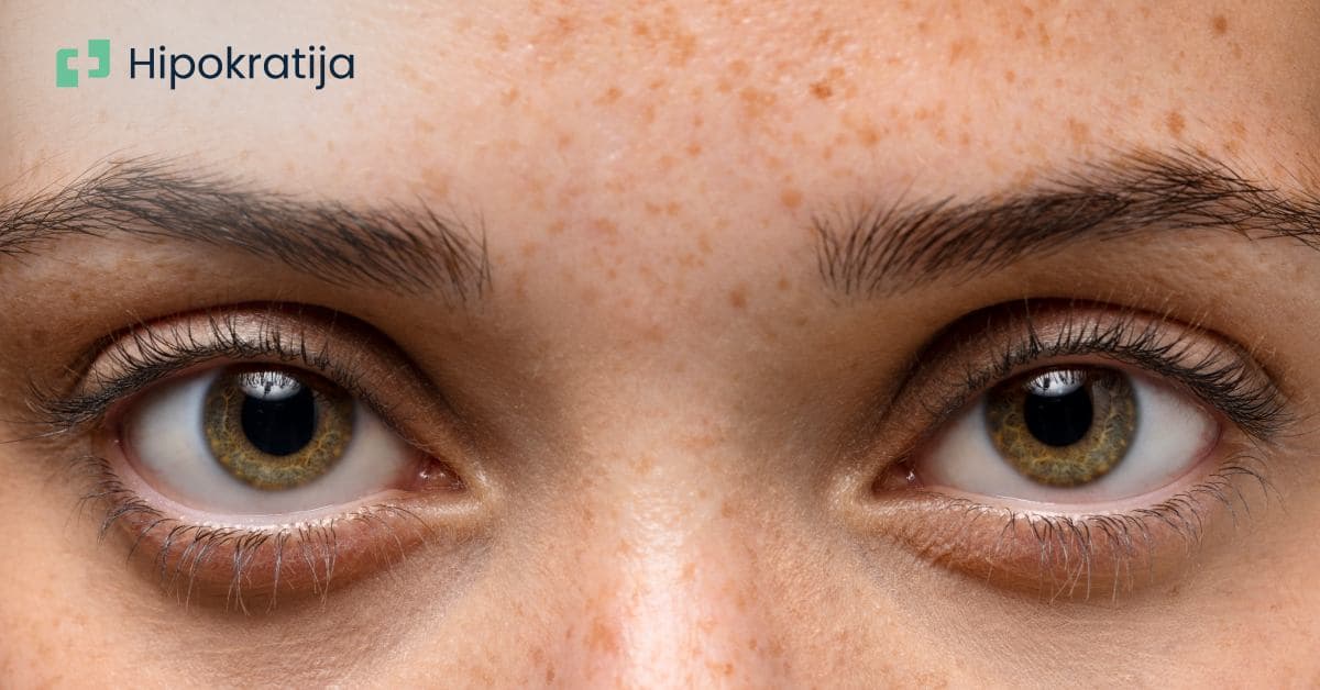 Cover Image for Hiperpigmentacija: Uzroci, vrste i najefikasniji tretmani