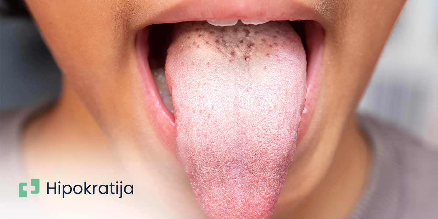 Cover Image for Kandida infekcija- simptomi, uzroci i liječenje