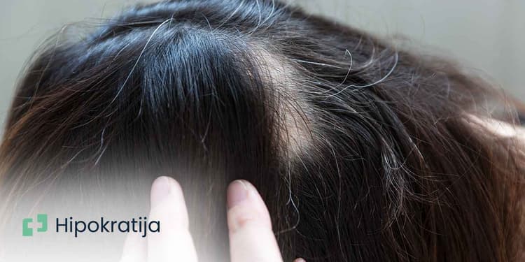 alopecija-simptomi-vrste-i-opcije-lijecenja