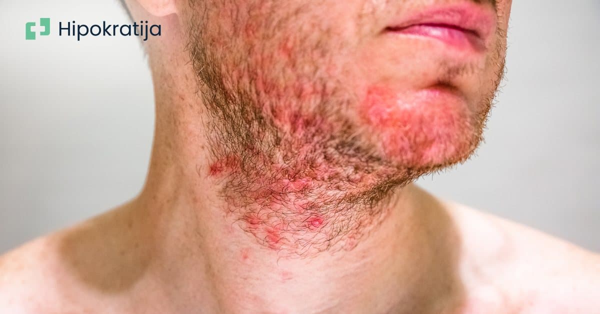 Cover Image for Seboroični dermatitis: Uzroci, simptomi i efikasni načini liječenja