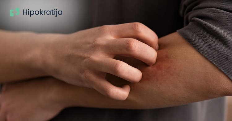 Ekcem na koži: kako izgleda, zašto se javlja i kako se liječi