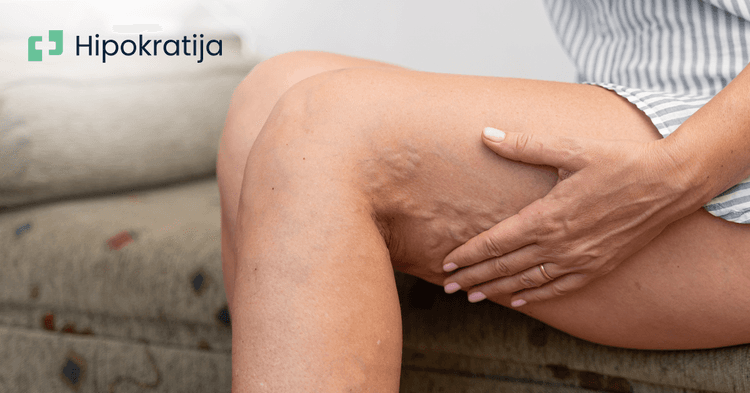 prosirene-vene-bolno-stanje-koje-zahteva-individualizovan-pristup-lecenju