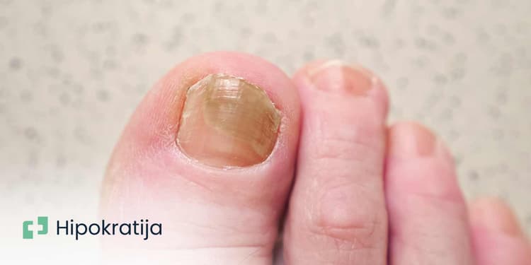 gljivice-na-noktima-kako-nastaju-i-kako-se-lece