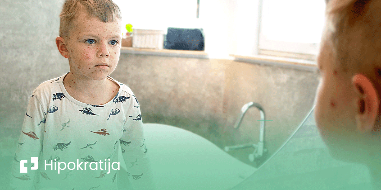 Cover Image for Boginje – kako da prepoznate simptome i reagujete u slučaju zaraze