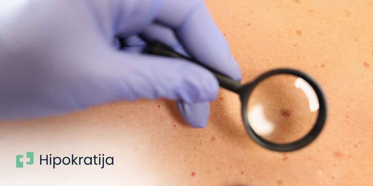 melanom-sve-sto-bi-trebalo-da-znate-o-ovom-obliku-raka-koze
