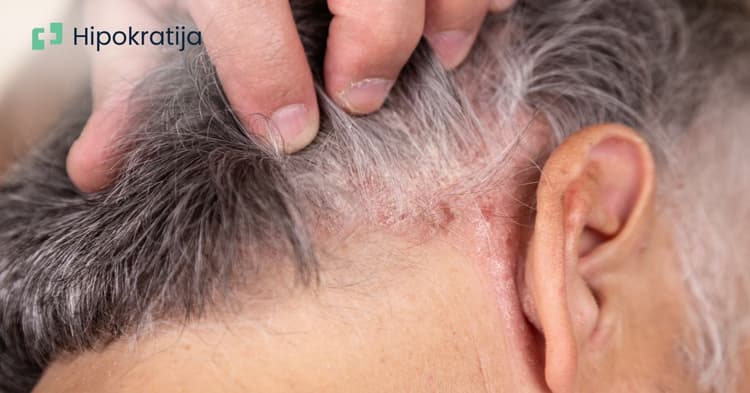 Psorijaza: Uzroci, simptomi i najefikasniji savjeti