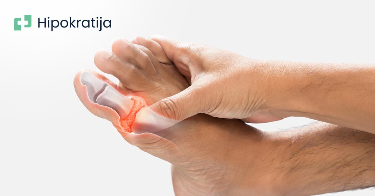 Cover Image for Šta je giht i kako se liječi