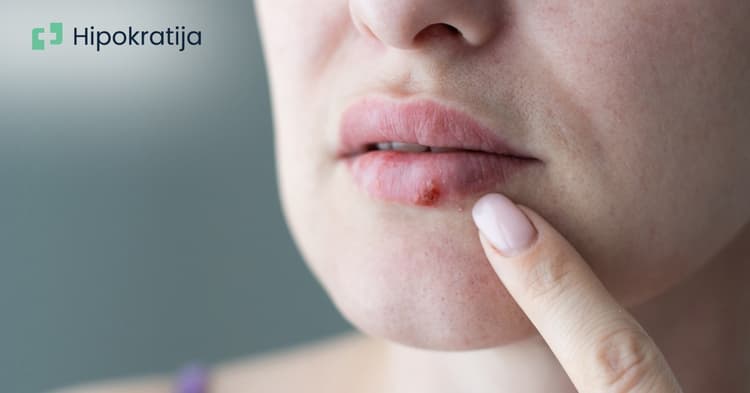 Sve o herpesu: Vrste, simptomi i kako sprečiti ponovna izbijanja